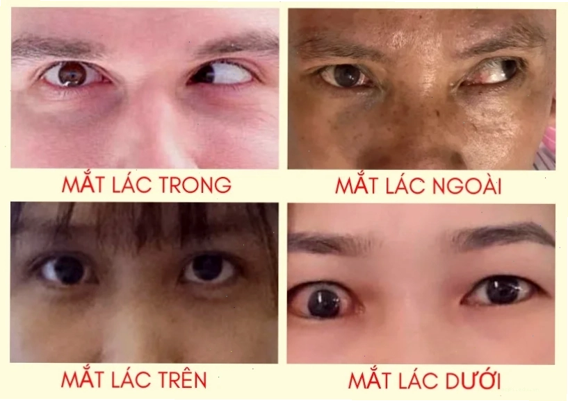 Meme mắt lác của người nổi tiếng