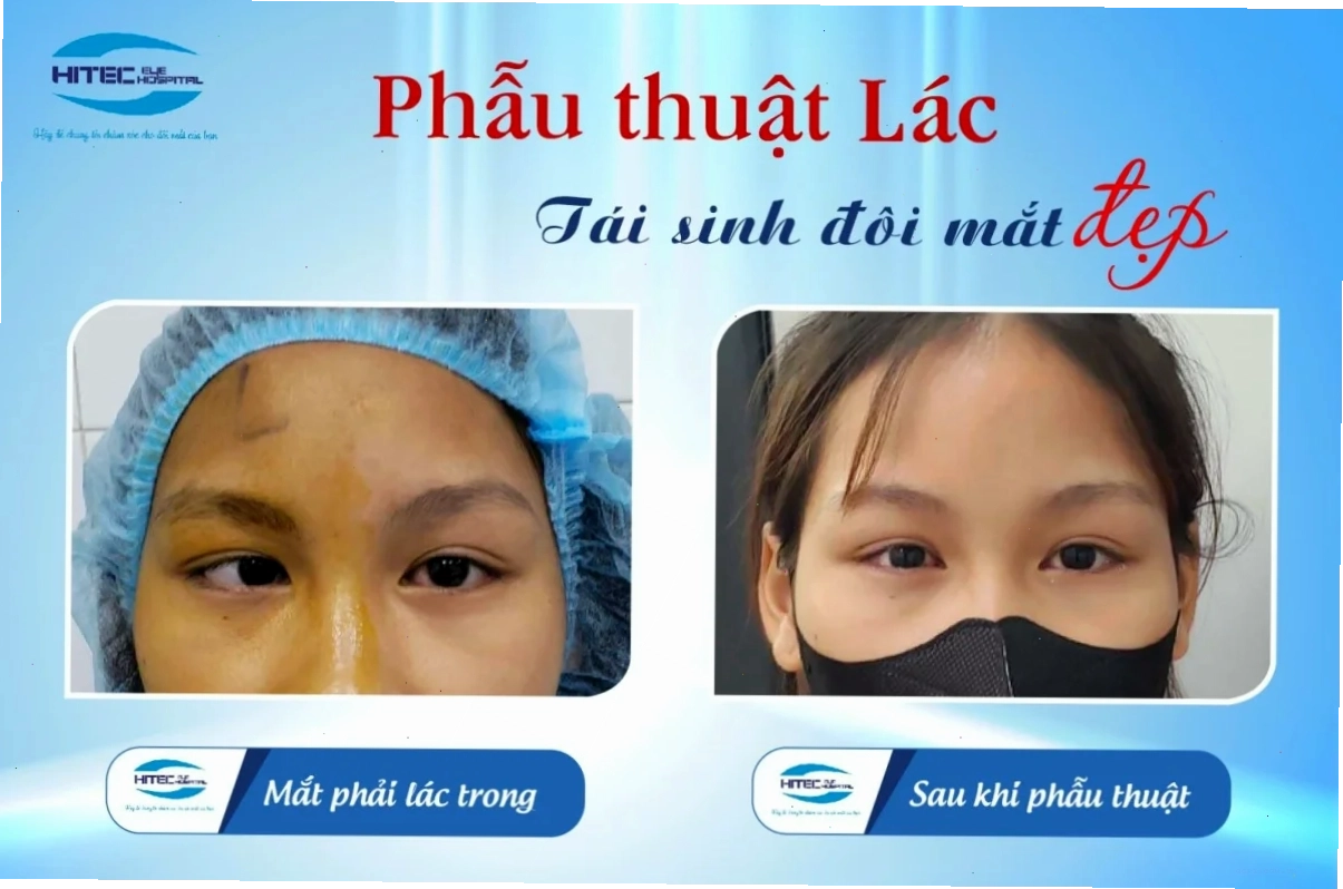 Meme mắt lác đầy màu sắc