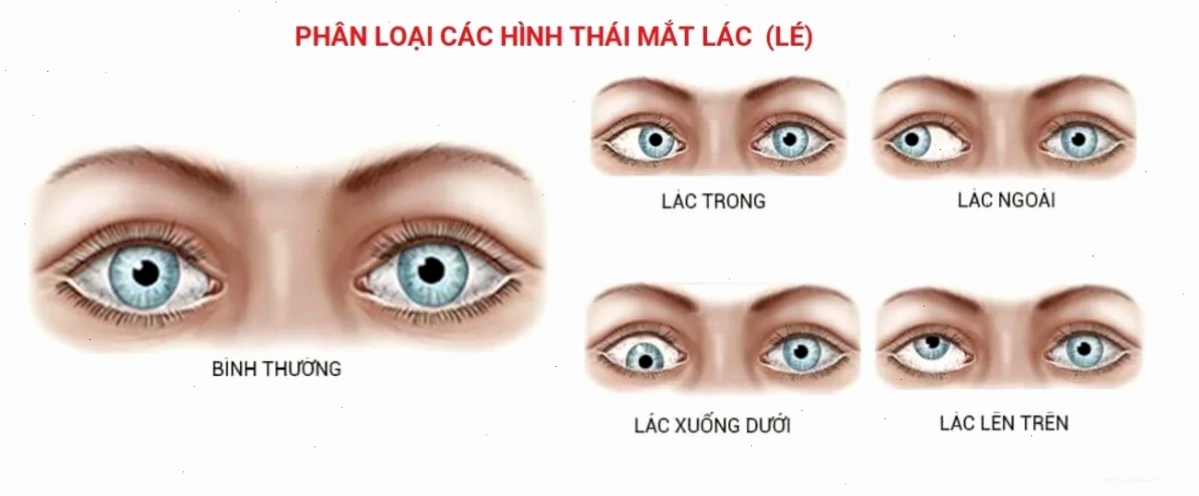 Meme mắt lác trong game